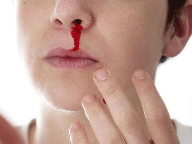 Làm thế nào để bóp chặt cánh mũi khi chảy máu cam?
