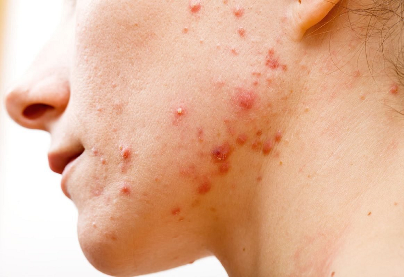 Các nguyên nhân gây viêm da mủ ở mặt và cách điều trị hiệu quả