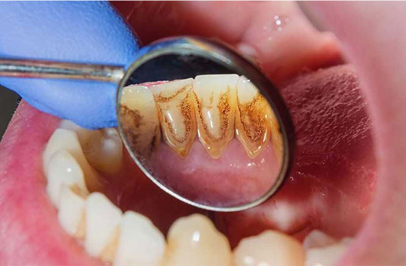 Điều gì xảy ra nếu không chăm sóc và loại bỏ vôi răng?
