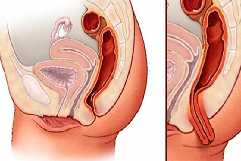 Bị sa tử cung có nguy hiểm không? (Is cervical prolapse dangerous?)
