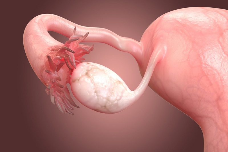 U nang buồng trứng ảnh hưởng đến khả năng mang thai?