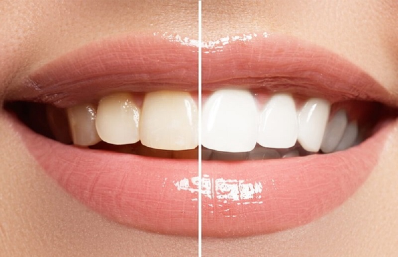Tẩy trắng răng là quá trình dùng các phản ứng oxy hóa như Carbamide Peroxide hoặc Hydrogen Peroxide kết hợp với ánh sáng để làm cho răng trở nên trắng sáng hơn là bình thường.