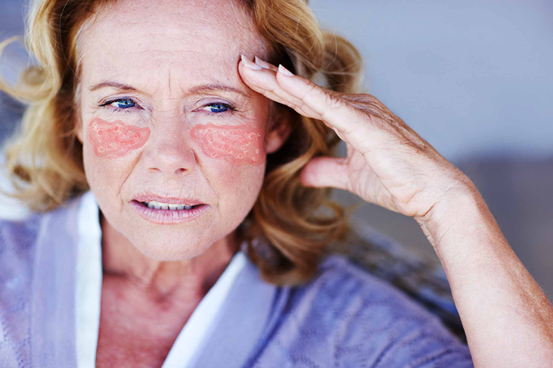 Bệnh lupus ban đỏ là gì và có những triệu chứng nào?
