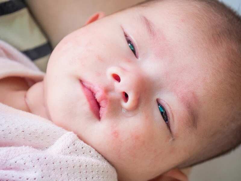 Những nguyên nhân em bé bị viêm da và cách điều trị hiệu quả