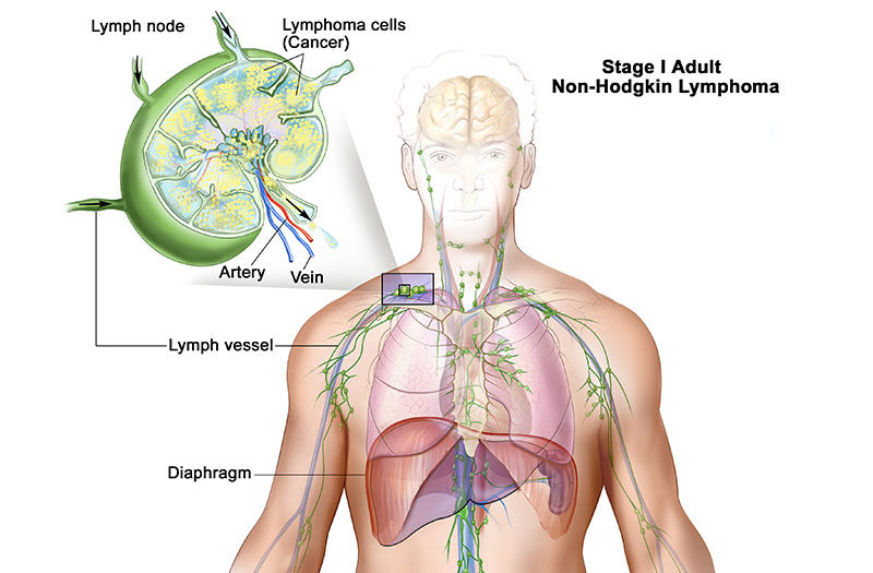 Ung thư hạch Hodgkin có diễn tiến như thế nào trong cơ thể?
