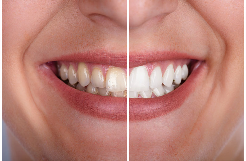Phản ứng hóa học có phải là phương pháp tẩy răng hiệu quả?
