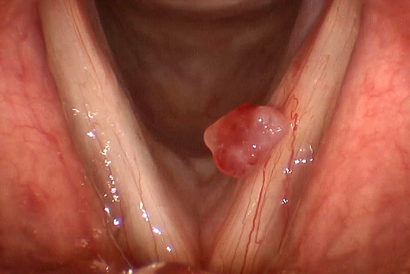 Polyp dây thanh quản xuất hiện do nguyên nhân gì?
