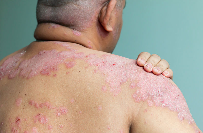 Các bệnh nào là bệnh ngoài da thường gặp và cách điều trị