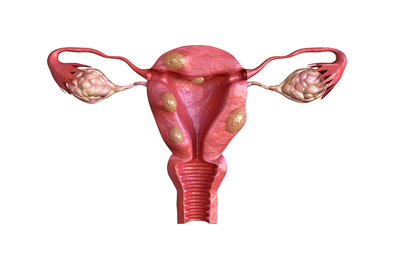 U xơ tử cung có ảnh hưởng đến quá trình mang thai và sinh con không?

