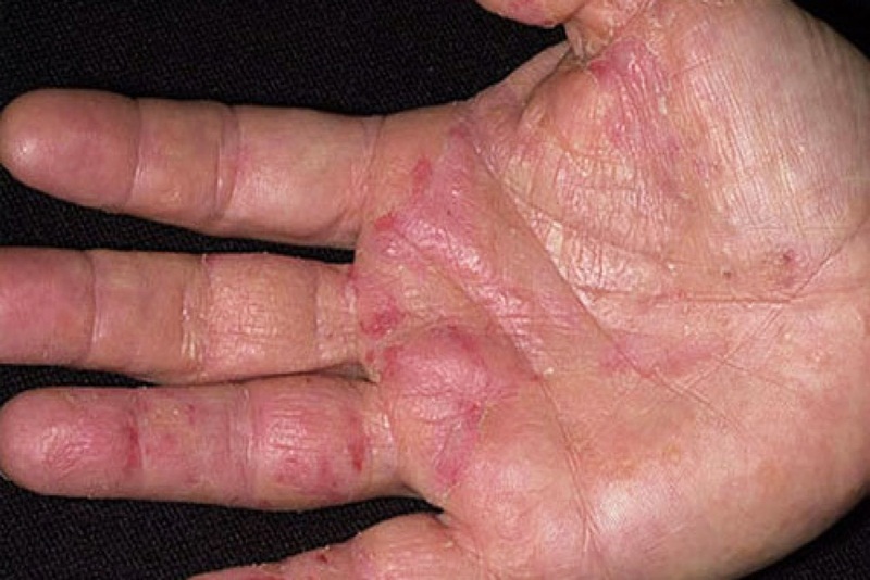 Phương pháp điều trị và cách phòng ngừa bệnh Eczema