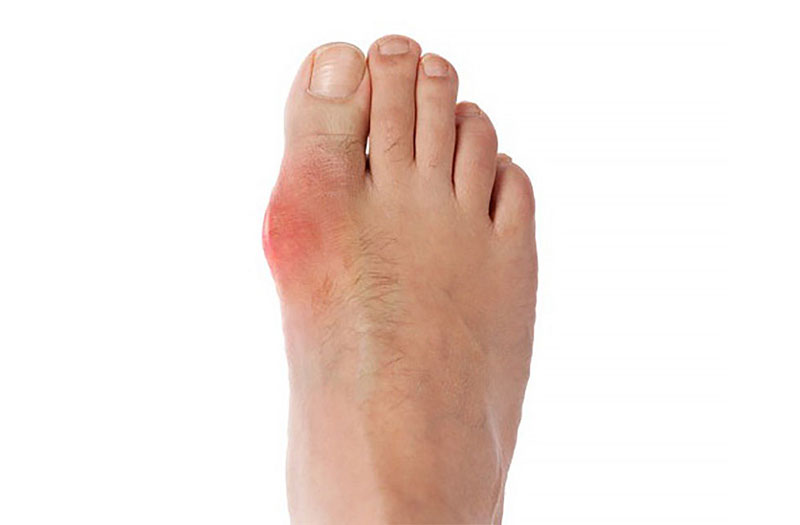 Những dấu hiệu bệnh gout ở chân mà bạn cần nhận biết