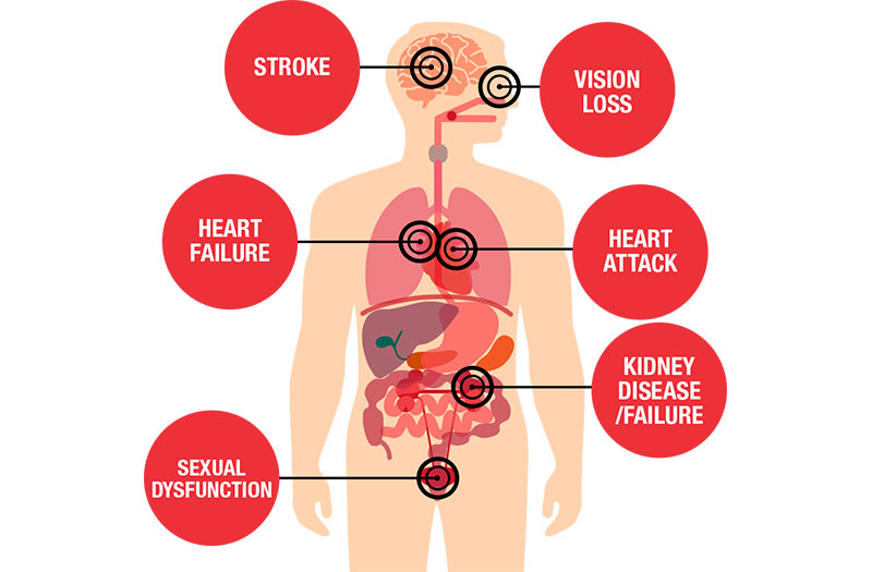Huyết áp cao có thể gây nguy hiểm như thế nào cho sức khỏe?