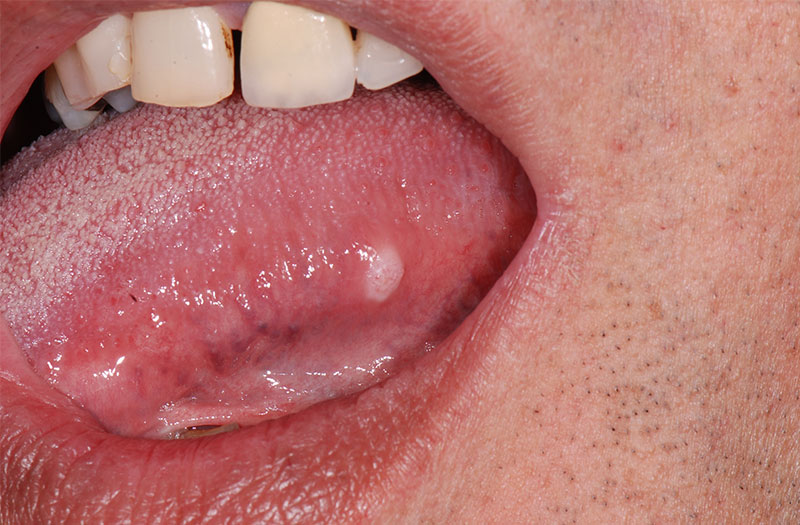 Triệu chứng của bệnh u lưỡi là gì?

