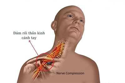 Chèn Ép Đám Rối Thần Kinh Cánh Tay: Nguyên Nhân, Triệu Chứng Và Cách Điều Trị Hiệu Quả