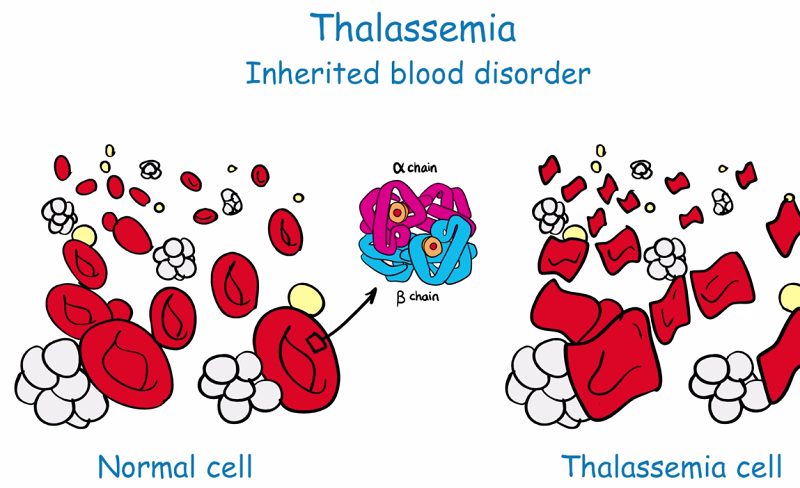 Nếu một người mang gen mang bệnh thalassemia và một người không mang gen bệnh, tỷ lệ con của họ bị bệnh là bao nhiêu?
