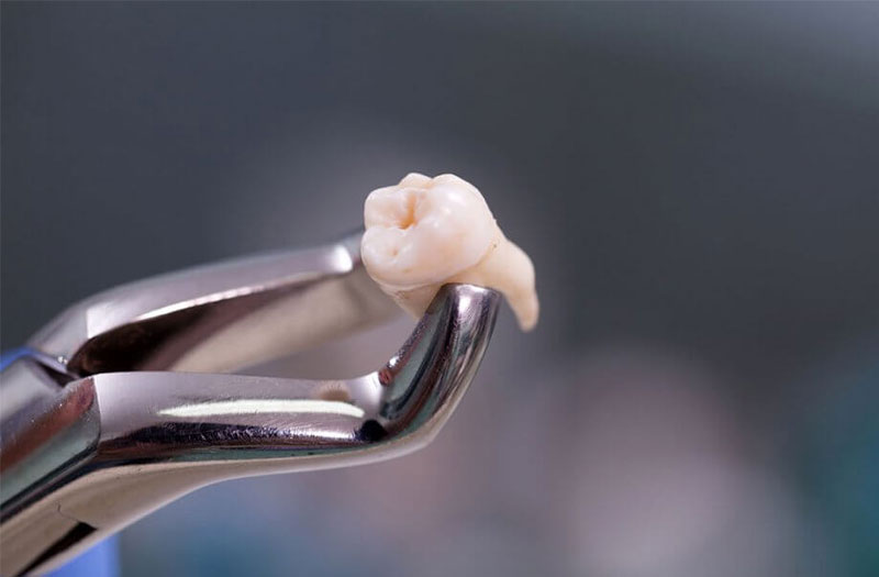 Đặc điểm và chức năng của răng khôn là răng số mấy mà bạn cần biết
