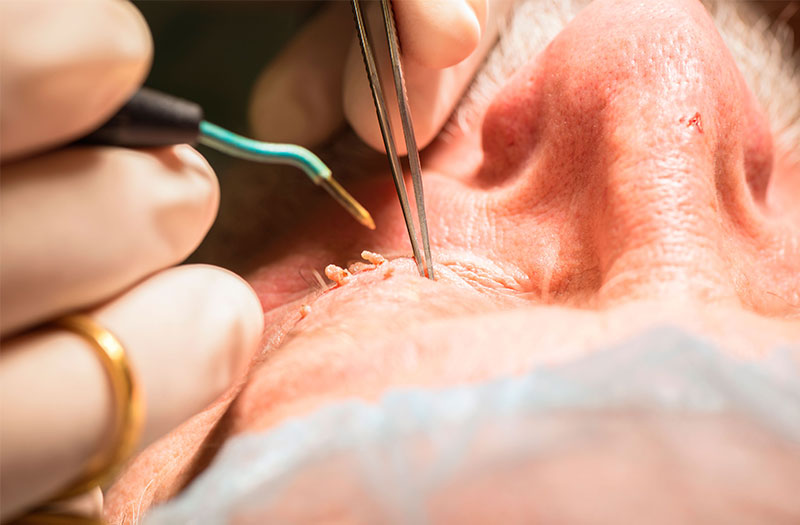 Các phương pháp điều trị bệnh sùi mào gà hiệu quả