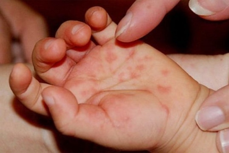 What is the importance of avoiding wind exposure in children with Hand, Foot, and Mouth Disease?