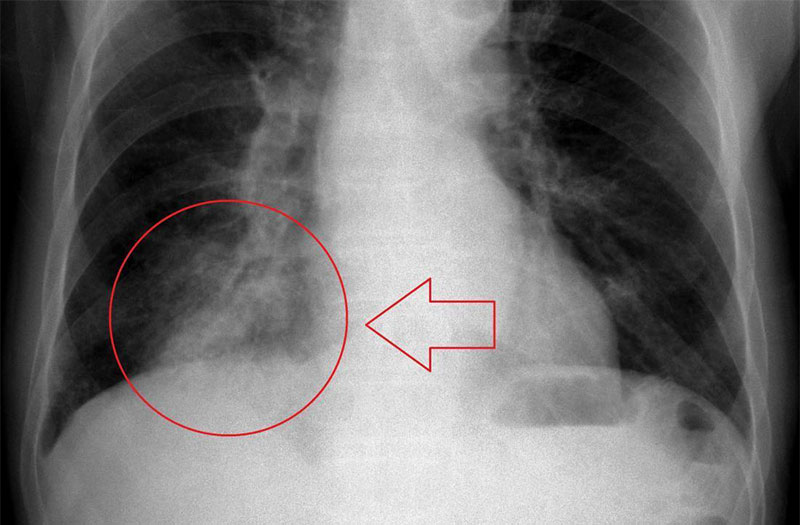 Có những dấu hiệu gì cho thấy bệnh nhân có thể đang mắc viêm phổi nặng?
