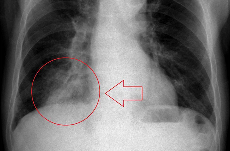 Các dấu hiệu và các triệu chứng viêm phổi phổ biến bạn cần biết