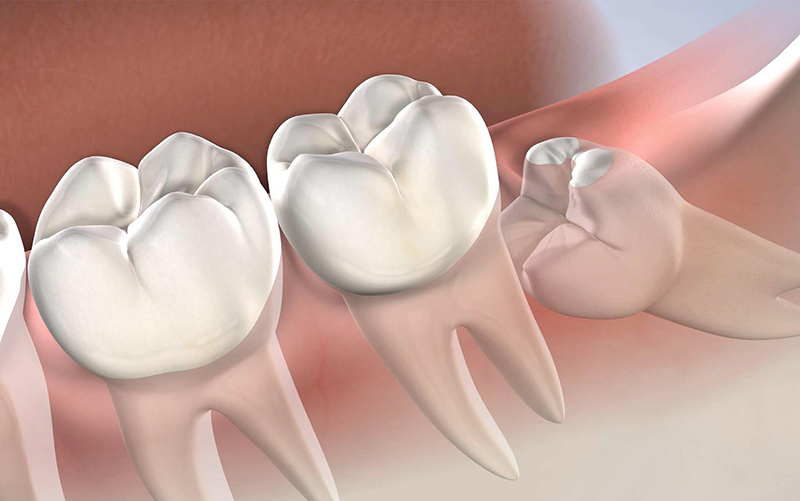 Nhổ răng khôn có thể sửa chữa lệch mặt hiện có?
