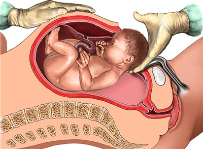 Ảnh Hưởng Của Phẫu Thuật Mổ Lấy Thai Ảnh Hưởng Của Phẫu Thuật Mổ Lấy Thai