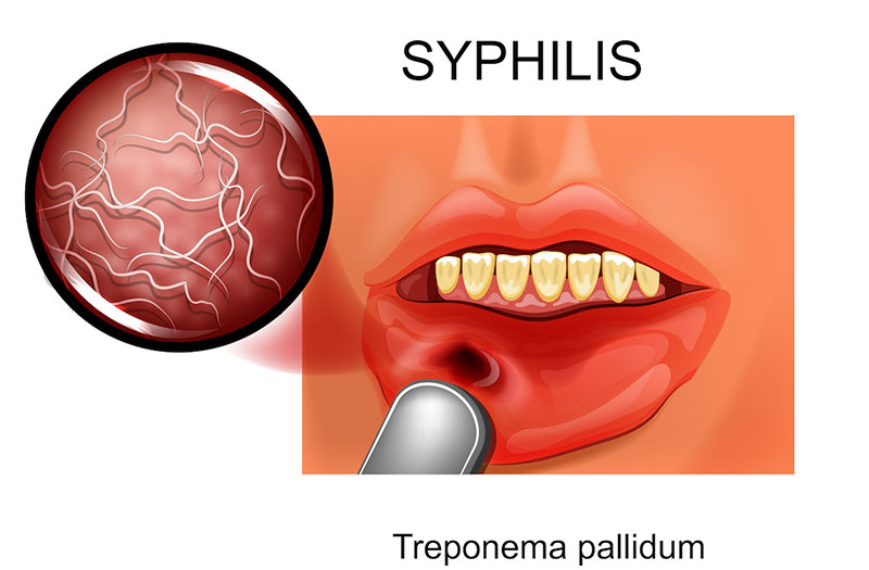  Giang mai ở miệng : Nguyên nhân, triệu chứng và cách phòng tránh