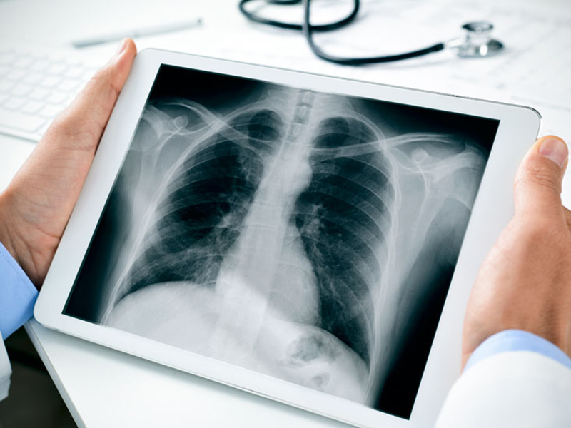 Triệu chứng chính của viêm màng phổi là gì?

