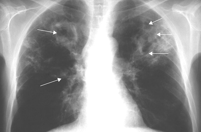  Lao phổi nguyên nhân - Cách điều trị và lời khuyên hữu ích