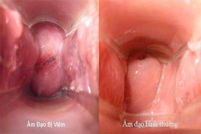 4. Phân Loại Viêm Âm Vật