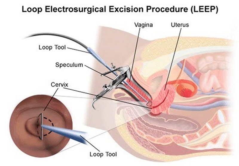 LEEP - Kỹ thuật đầu tay điều trị cổ tử cung