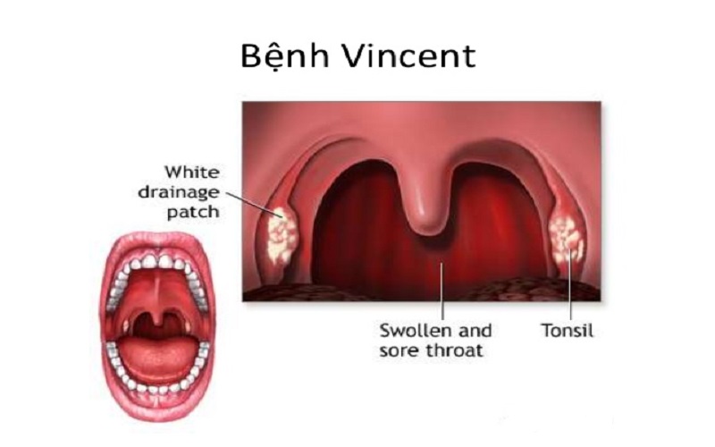 Biểu hiện và cách điều trị viêm họng vincent hiệu quả