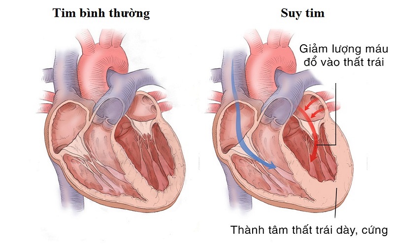 Quy trình xét nghiệm BNP như thế nào?
