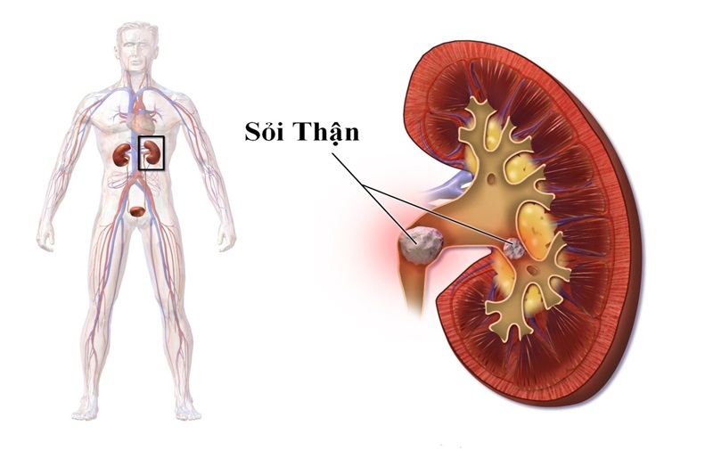 Phương pháp điều trị sỏi thận bằng thuốc là gì?
