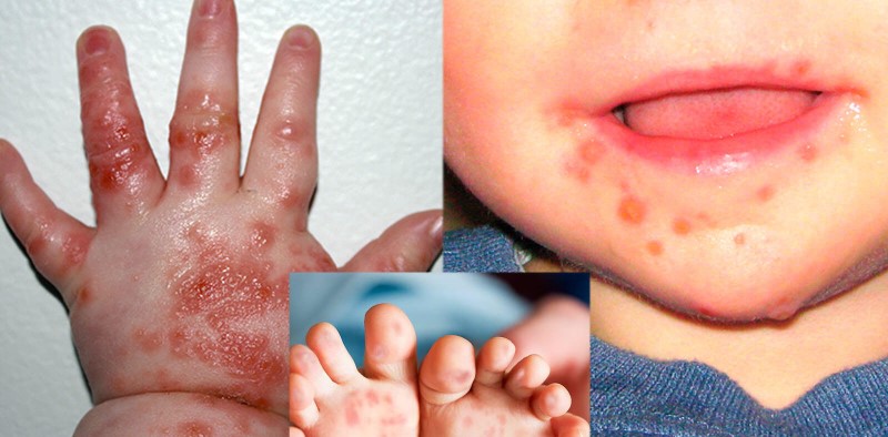 Enterovirus 71 nguyên nhân của bệnh tay chân miệng ở trẻ em
