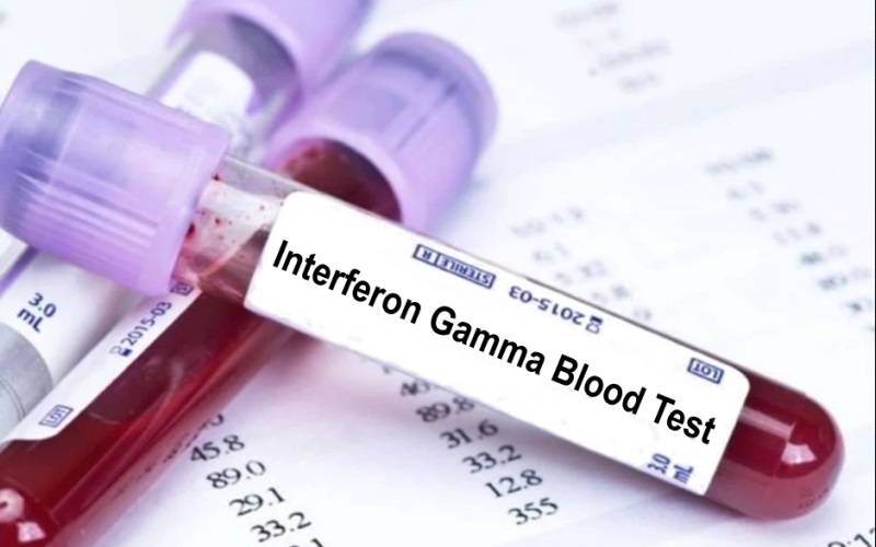Xét nghiệm igra tìm điểm khác biệt so với phương pháp thử máu qua da là gì?
