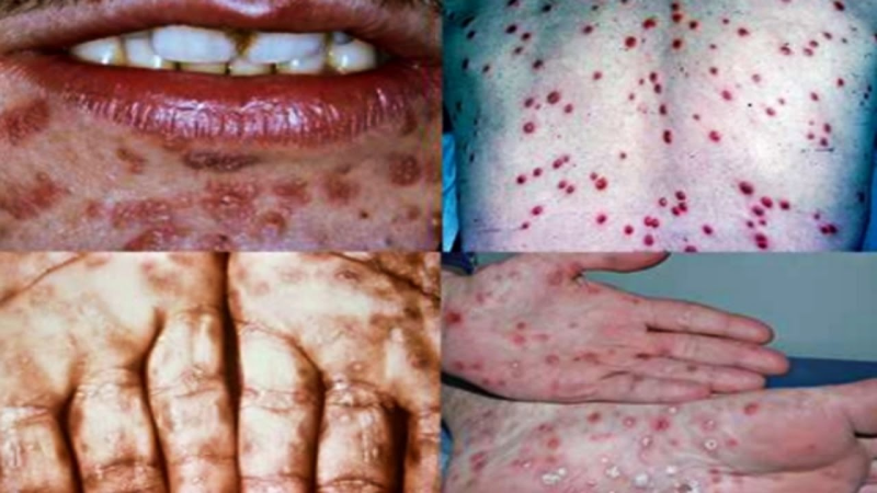 Xét nghiệm Syphilis TP trong chẩn đoán bệnh giang mai