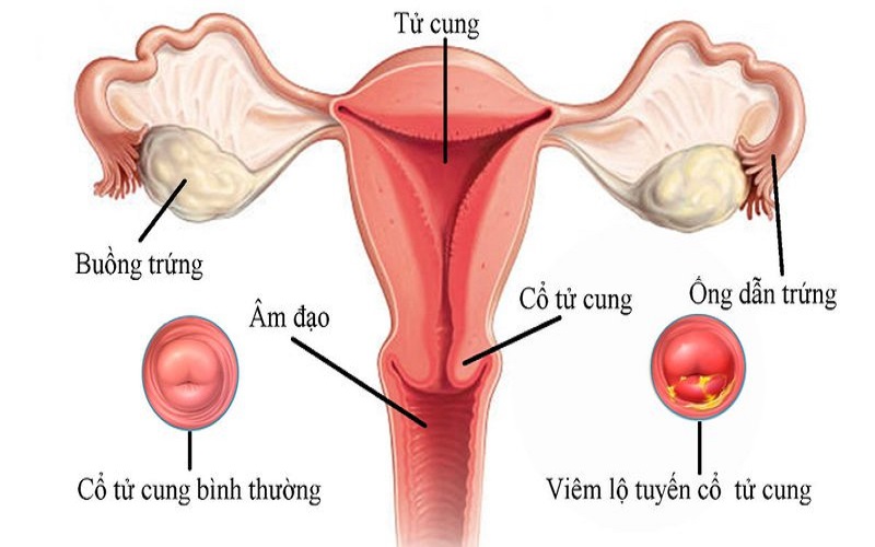 Phương pháp chẩn đoán viêm lộ tuyến cổ tử cung?
