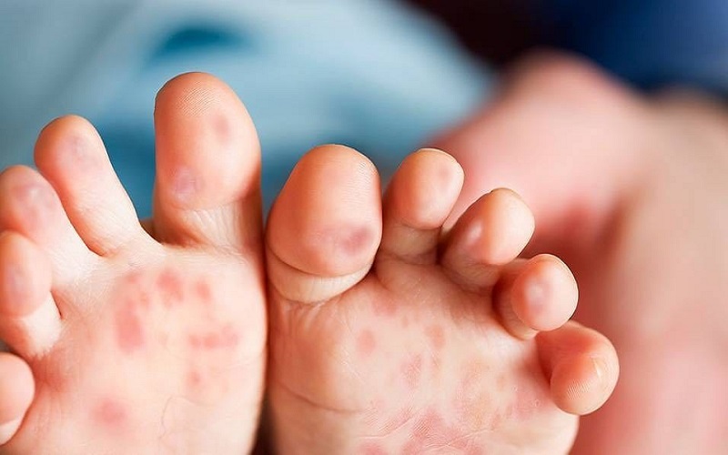 Những đốm nhỏ màu đỏ xuất hiện ở đâu trên cơ thể của trẻ sơ sinh khi bị bệnh tay chân miệng?
