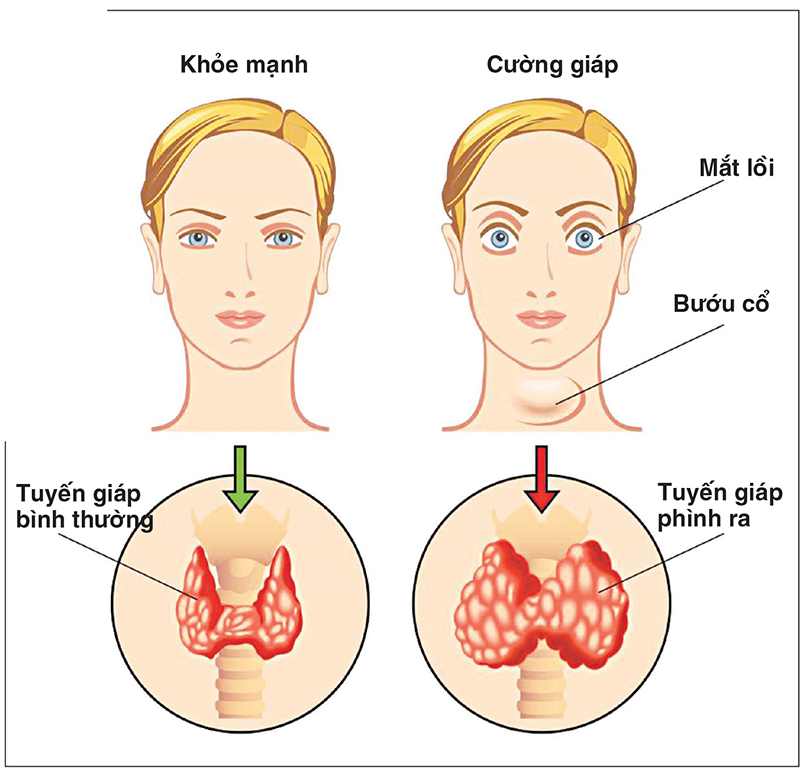 Quá trình phục hồi sau phẫu thuật mổ tuyến giáp nội soi kéo dài bao lâu?
