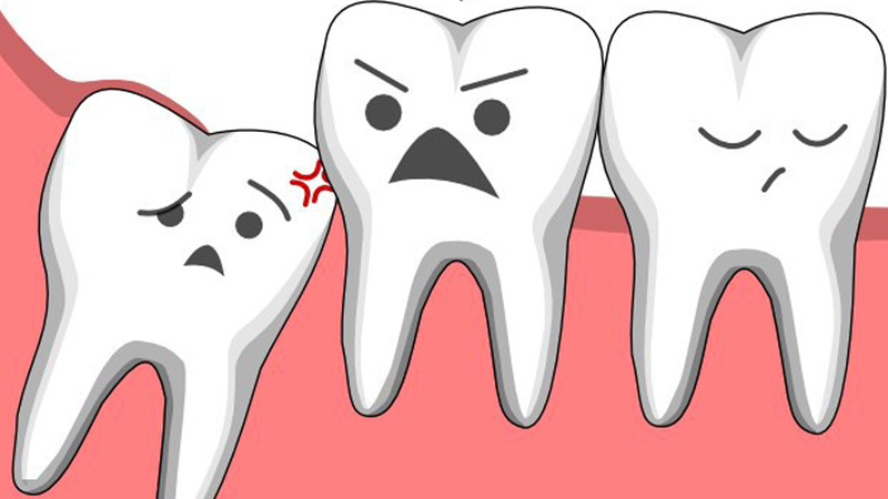 X quang răng khôn mọc lệch làm đau đớn và gây hỏng cấu trúc hàm răng có khi?
