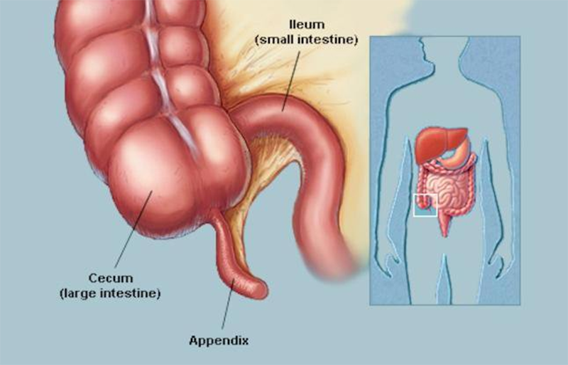 Triệu chứng chính của viêm ruột thừa là gì?
