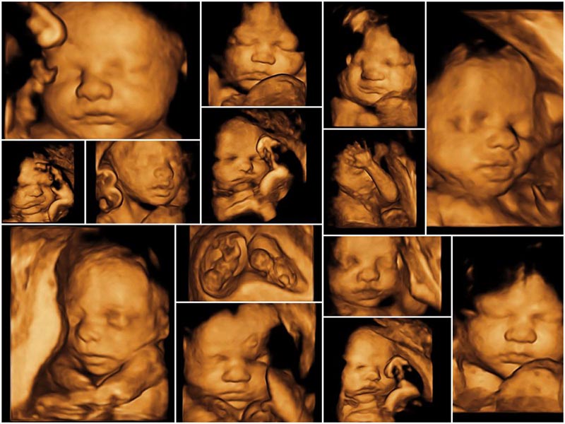 Tìm hiểu về siêu âm 4d thai 18 tuần và những hình ảnh đáng yêu