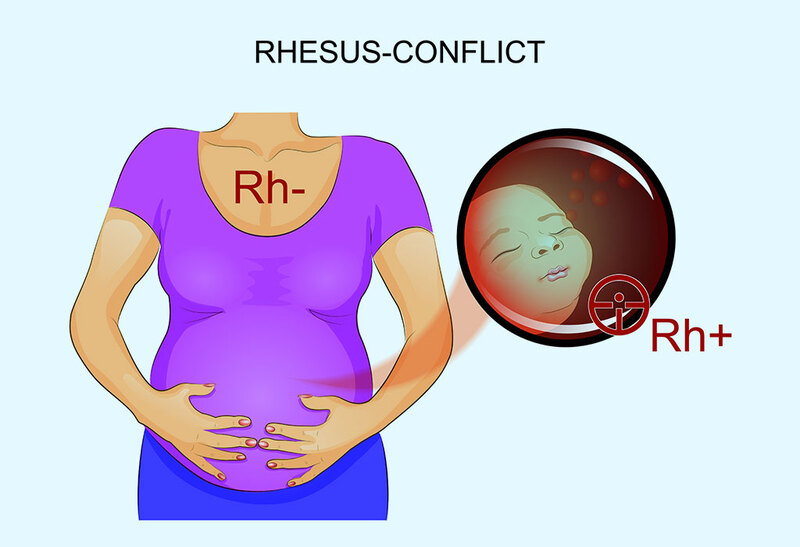 Có cách nào để điều trị xung huyết Rh khi mẹ mang nhóm máu Rh- và cha mang nhóm máu Rh+?
