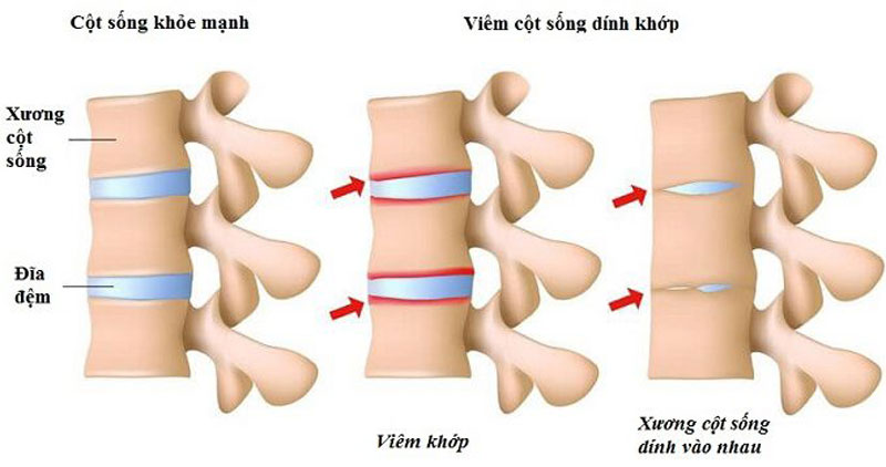 Xét nghiệm viêm cột sống dính khớp bao gồm những chỉ số nào?
