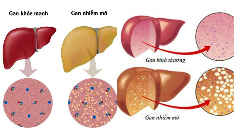 Gan nhiễm mỡ uống gì thanh lọc cơ thể, tốt cho sức khỏe?