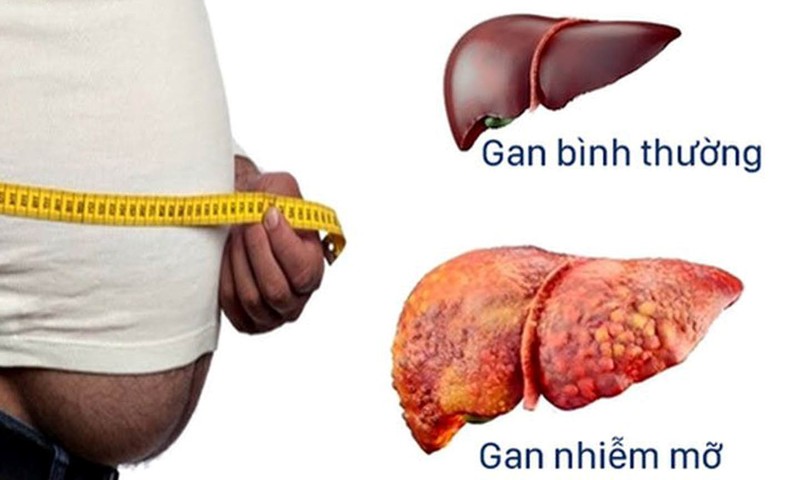 Các triệu chứng của gan nhiễm mỡ?
