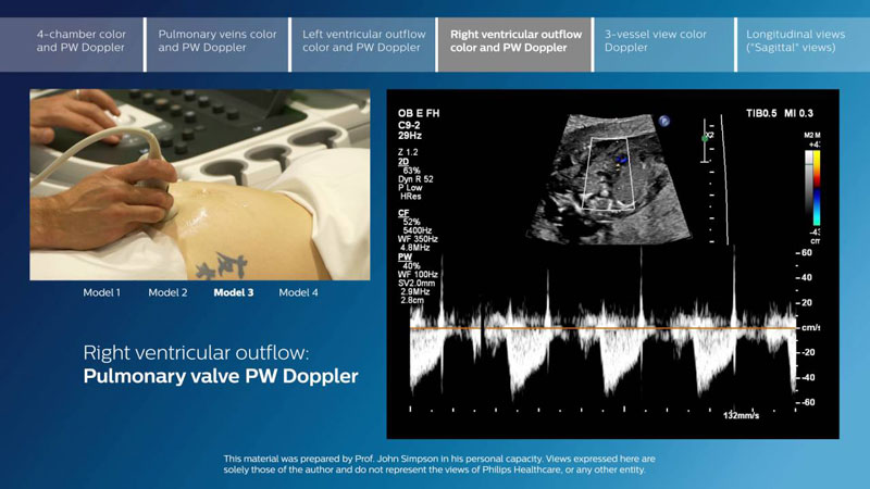 Tầm quan trọng của siêu âm doppler màu trong chuẩn đoán tim mạch