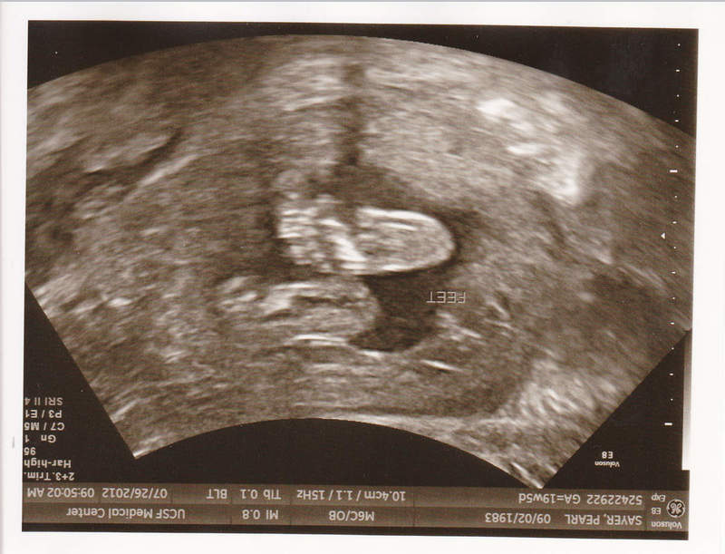 Tìm hiểu về siêu âm thai 2 tháng và những thay đổi của thai nhi