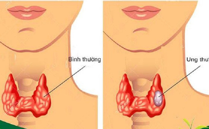 Triệu chứng và cách điều trị ung thư tuyến giáp di căn hạch để giảm đau và làm lành vết thương